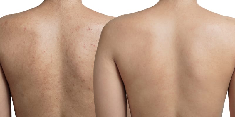 Back Facial London Before and After Back Facial London Before and After