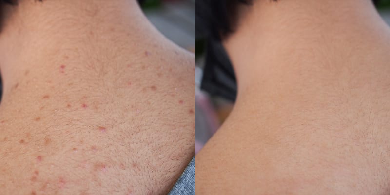 Back Facial Treatment Before and After