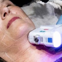 HIFU London High Intensity Focused Ultrasound Therapy Hannah London