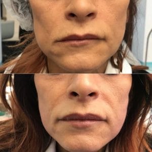 HIFU Treatment Before and After 2