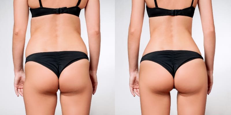 Hyacorp Treatment Before and After Hyacorp Treatment Before and After