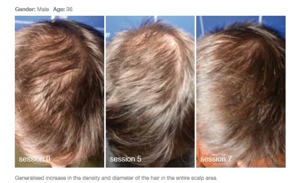 Meoshyal stock photo - Hair loss1