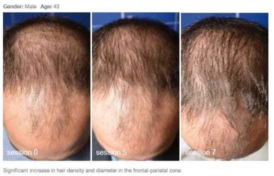 Meoshyal stock photo - Hair loss2