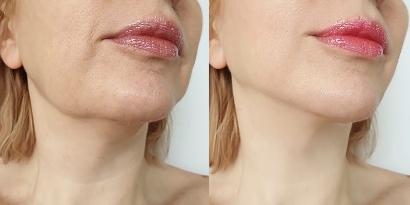 Profhilo Treatment Before and After Hannah London Profhilo Treatment Before and After Hannah London