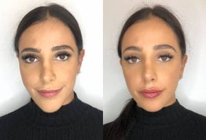 Lip Filler Treatment London BeforeAfter