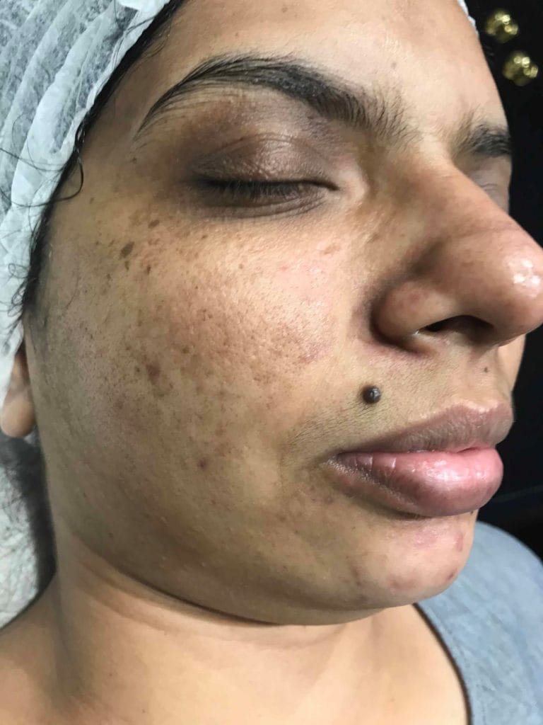 Skin-Peels-London-Cosmelan-Depigmentation-Peel-before