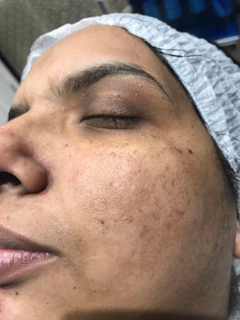Skin-Peels-London-Cosmelan-Depigmentation-Peel-before right