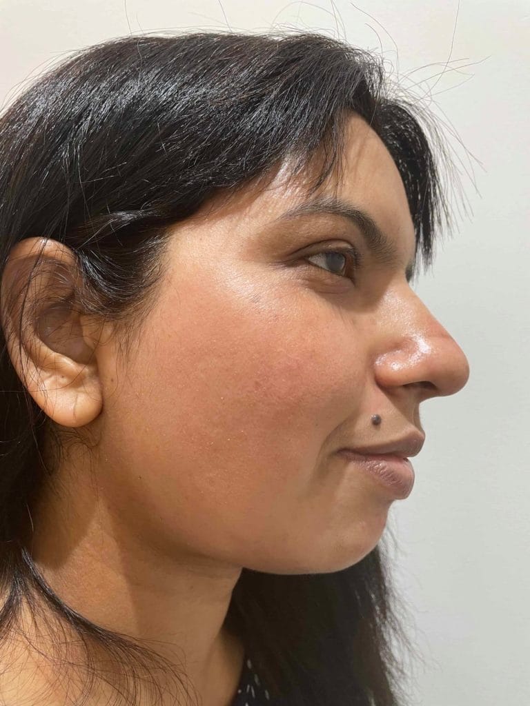 Skin-Peels-London-Cosmelan-Depigmentation-Peel-after