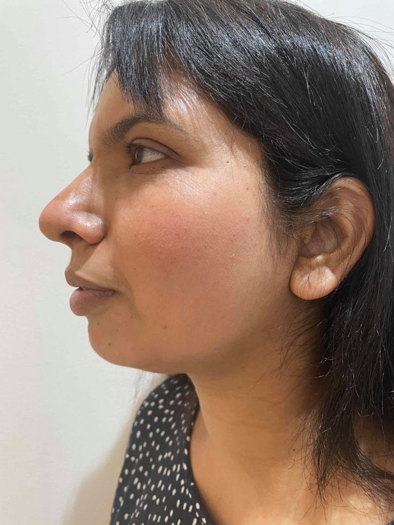 Skin-Peels-London-Cosmelan-Depigmentation-Peel-after right cheek