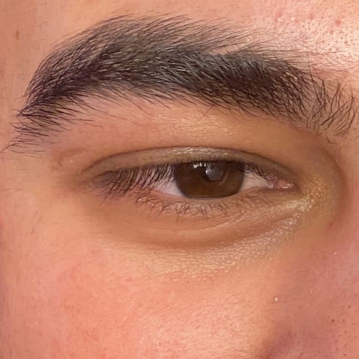 Tear Troughs Before and After male 1