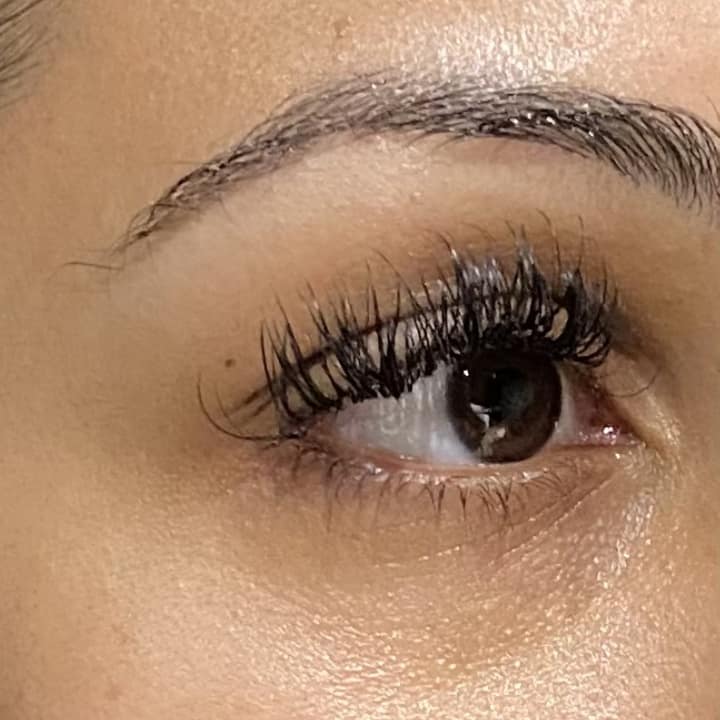 Tear Troughs - before and after1