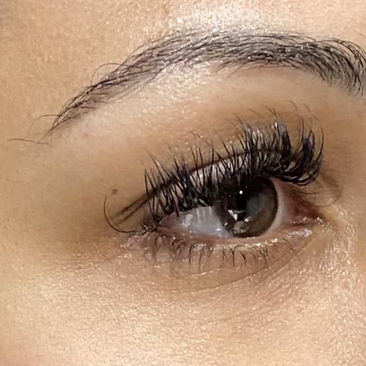 Tear Troughs - before and after2