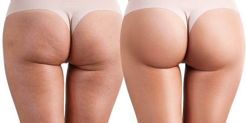 Sculptra Treatment London Before and After Sculptra Treatment London Before and After