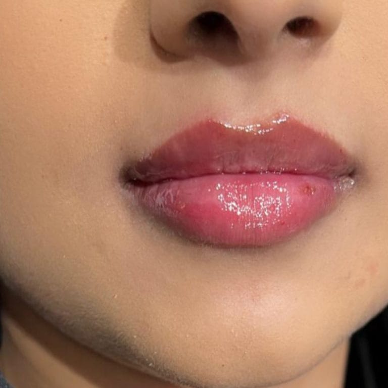 Lip Filler Dissolving Treatment using Hyalase (Hyaluronidase) in London Lip Filler Dissolving Treatment using Hyalase (Hyaluronidase) in London