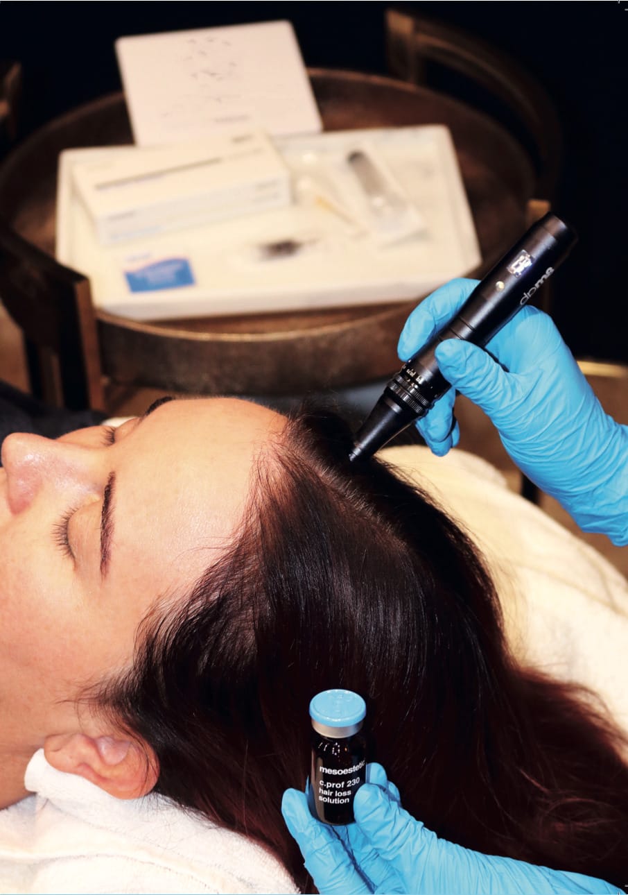 Mesotherapy for Hair Loss treatment in London Mesotherapy for Hair Loss treatment in London