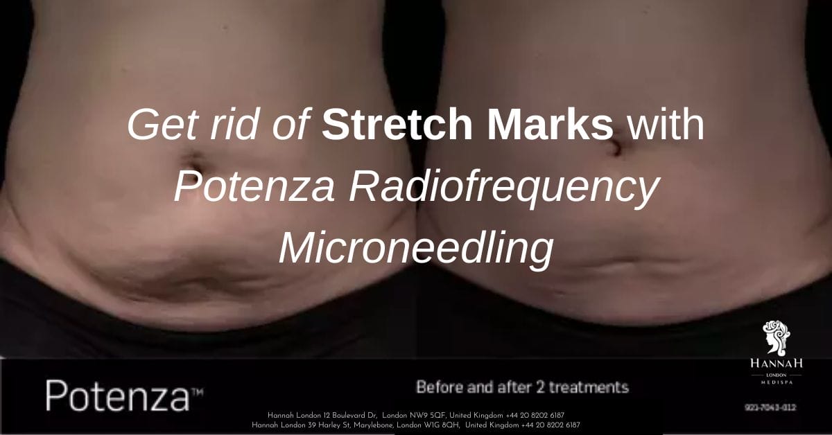 Remove Stretch Marks with Potenza Radiofrequency Microneedling Treatment